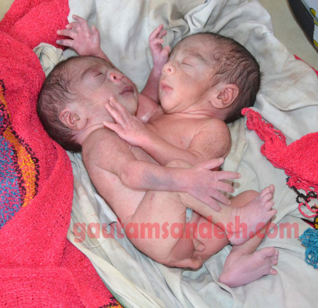 अविकसित बच्चा।